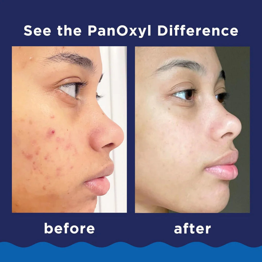 Before and after comparison of a person's face with acne treatment, featuring the PanOxyl brand.