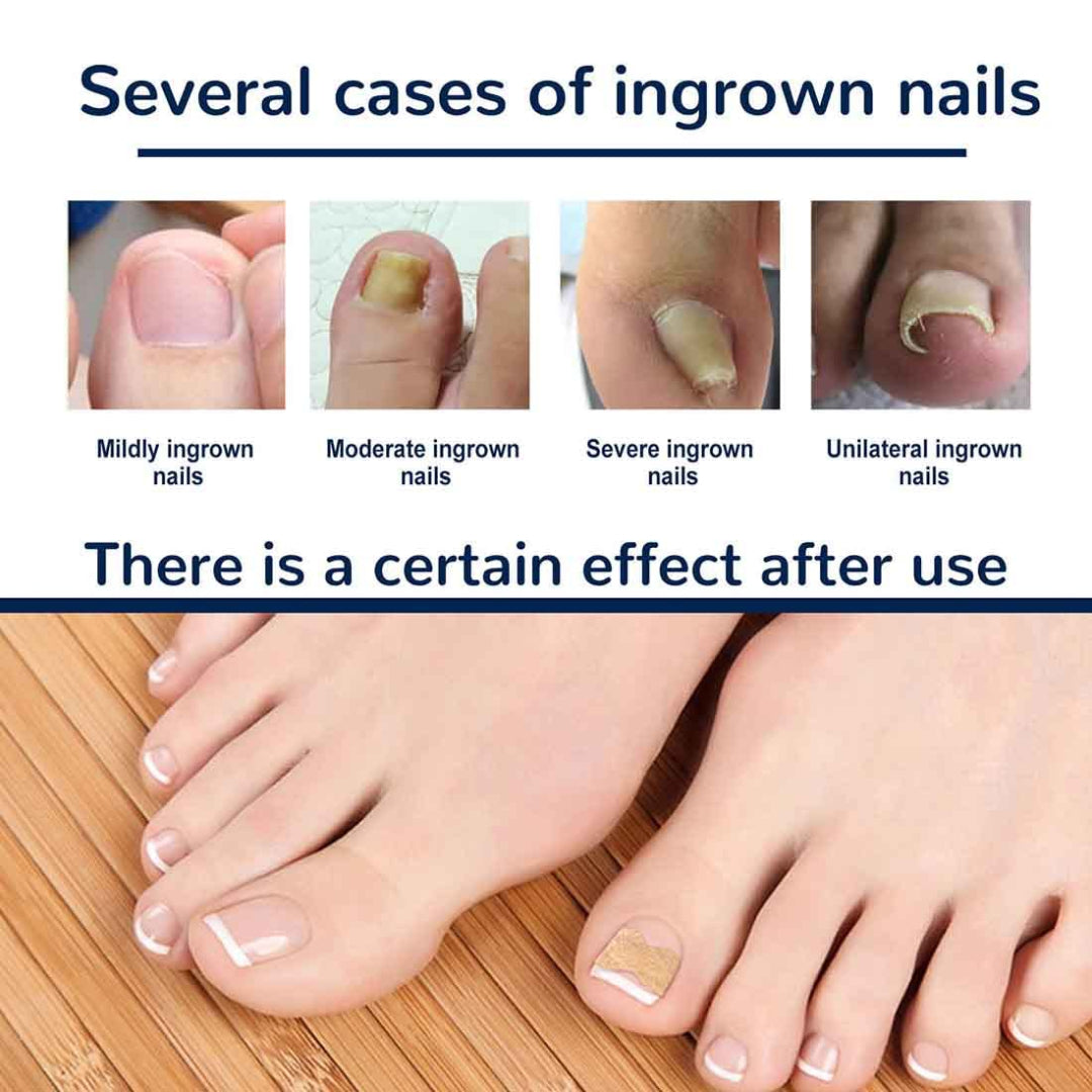 Illustration of ingrown nails with different severity levels and a foot with a bandage on a wooden floor.