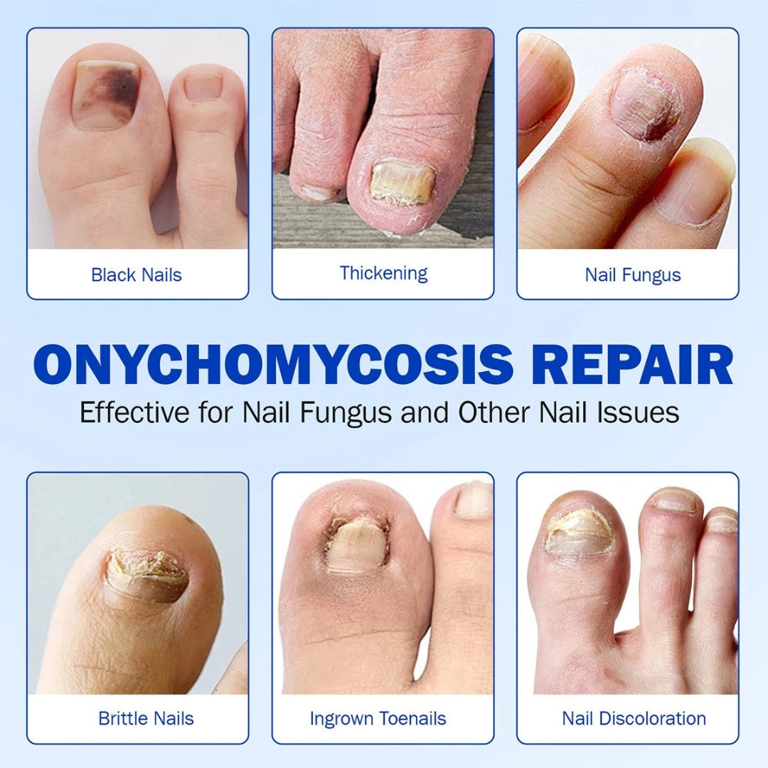 Images of nail issues with text on onychomycosis repair and its effectiveness.